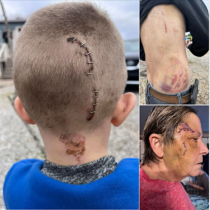 Being tossed in a tornado and its debris created a variety of injuries to the Koon family that required extensive staples and stitches, leaving the surviving family members bruised and in pain. Image: Jackie Koon / Facebook