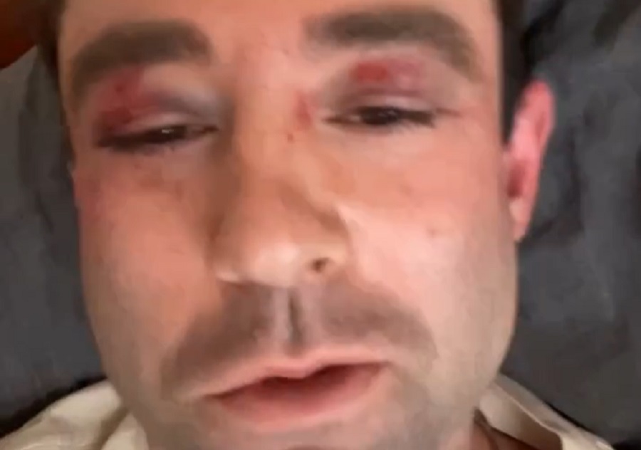 Adam Klotz shares his wounds from his subway attack on his Instagram today. Image: Adam Klotz / Instagram